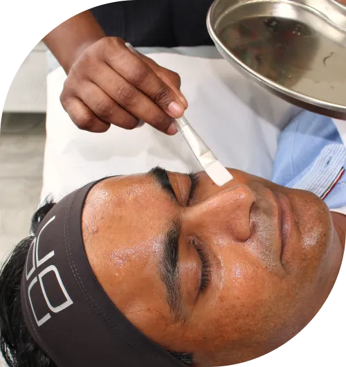 Chemical Peel Treatment Chester