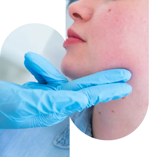 Chin Fillers Treatment