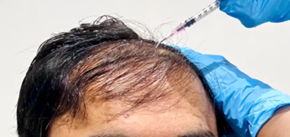 Microneedling for hair loss treatment