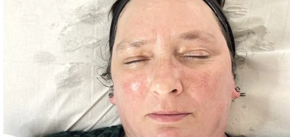Dermapen for acne scars and fine lines