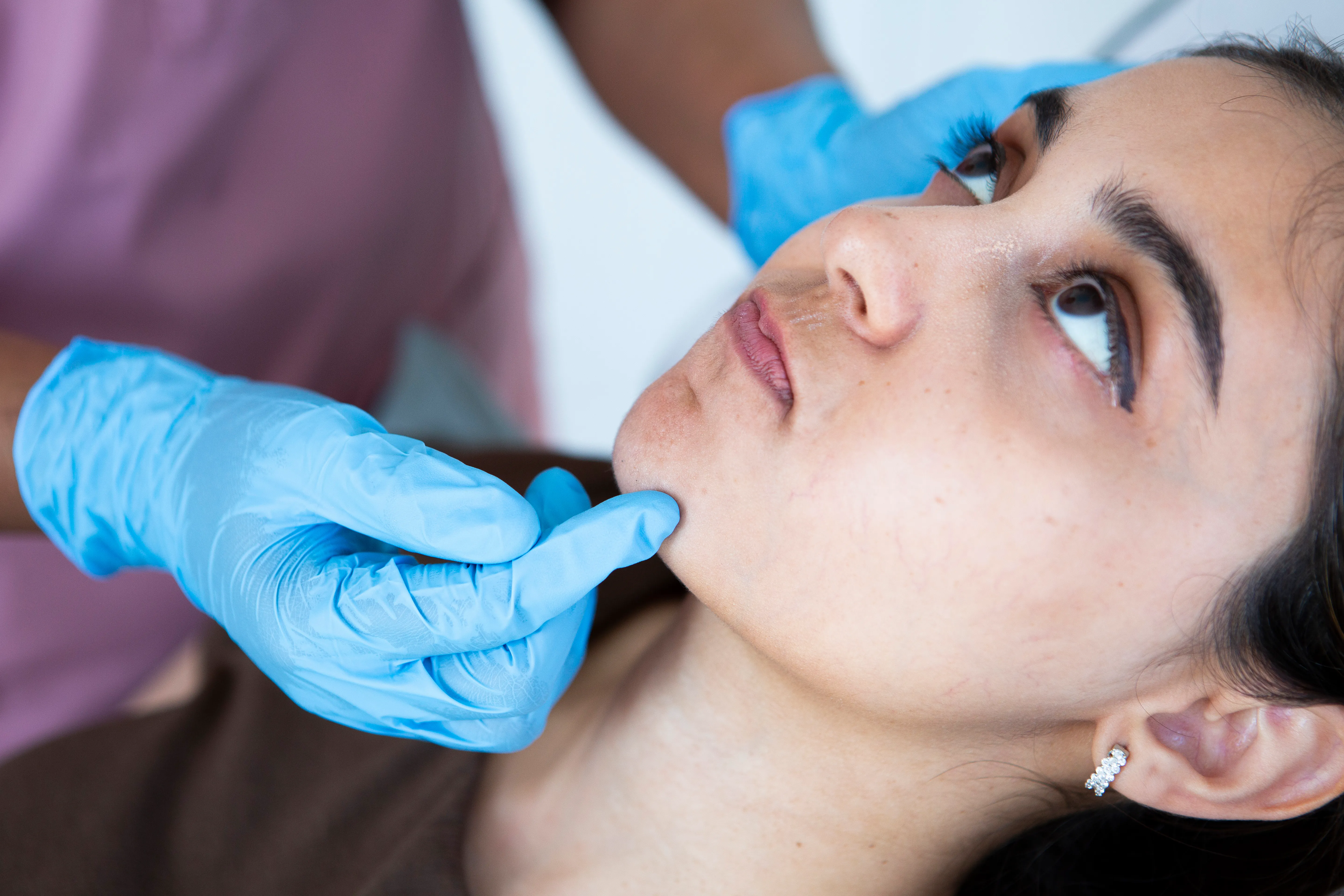 Jawline fillers in Chester for chin reshaping