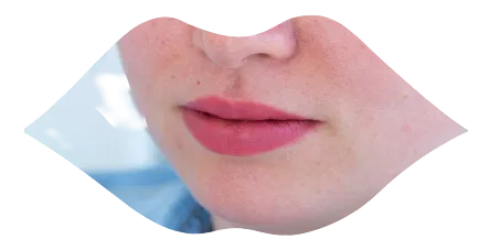 Lip wrinkle treatment for smoker's lines